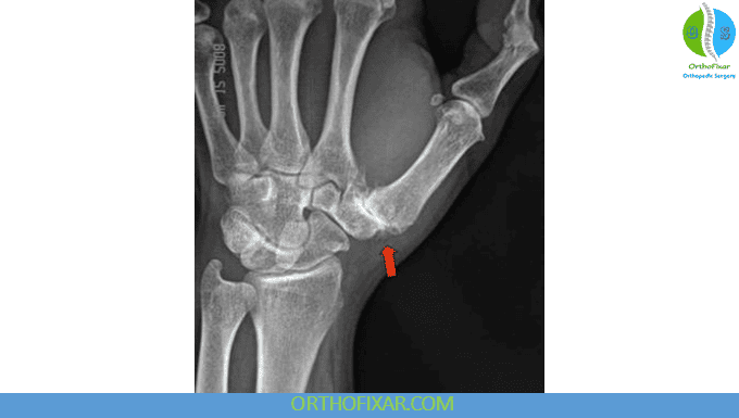 Thumb CMC Arthritis xray