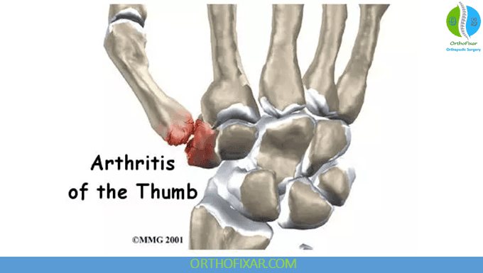 Thumb CMC Arthritis