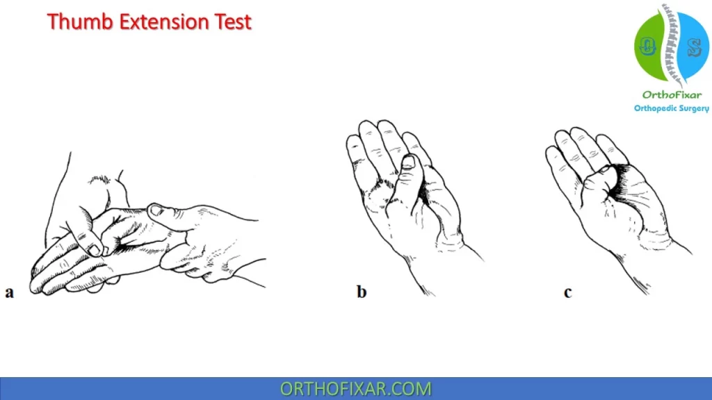 Thumb Extension Test