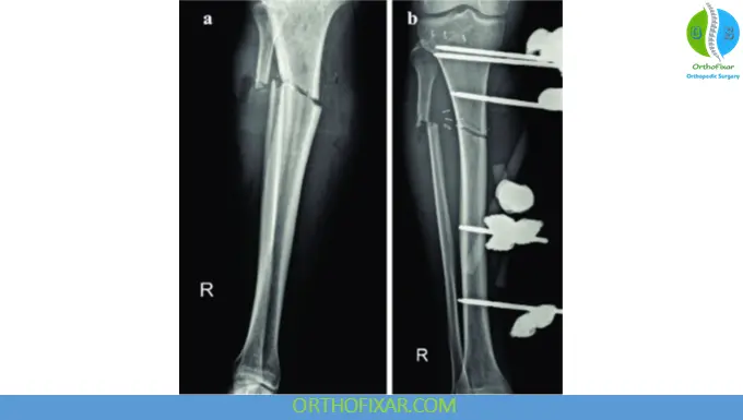 Tibia Fracture External Fixation treatment