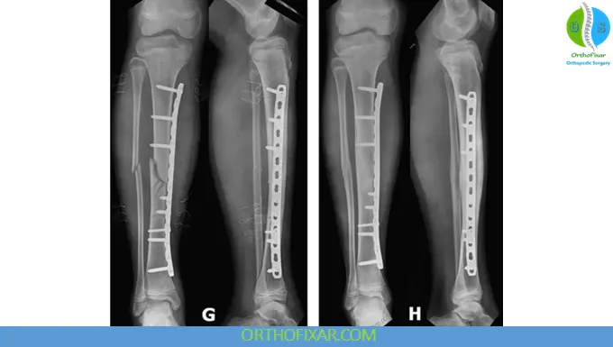Tibia Fracture Plating surgery treatment