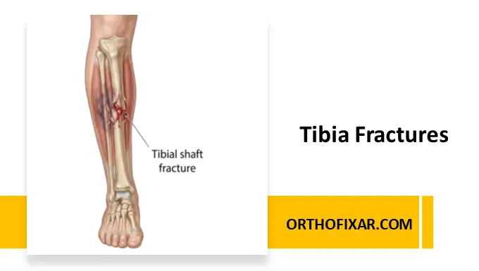 Tibia Fracture
