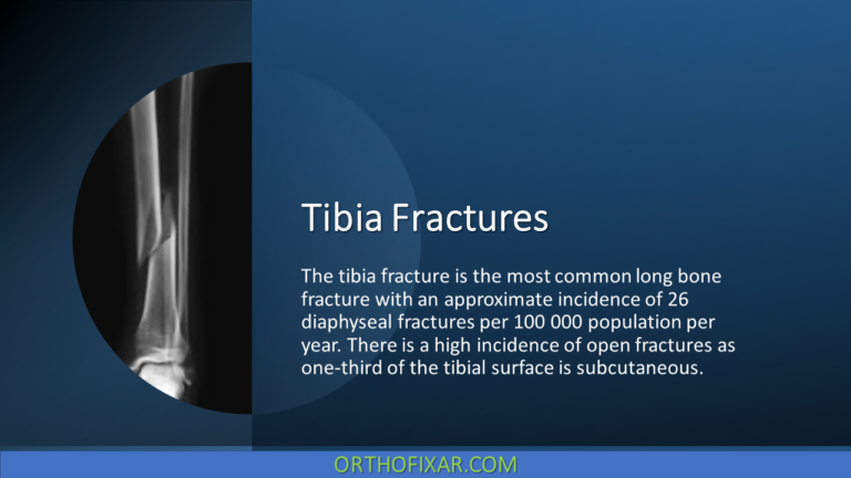 Tibia Fractures