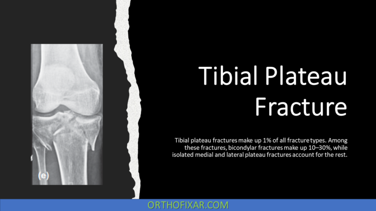 Tibial Plateau Fracture