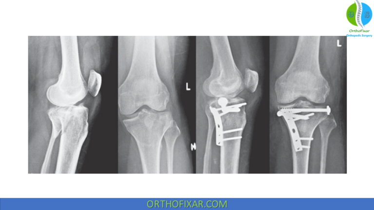 Tibial Plateau Fracture Orthofixar 2025