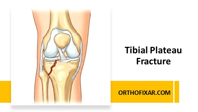 Tibial Plateau Fracture