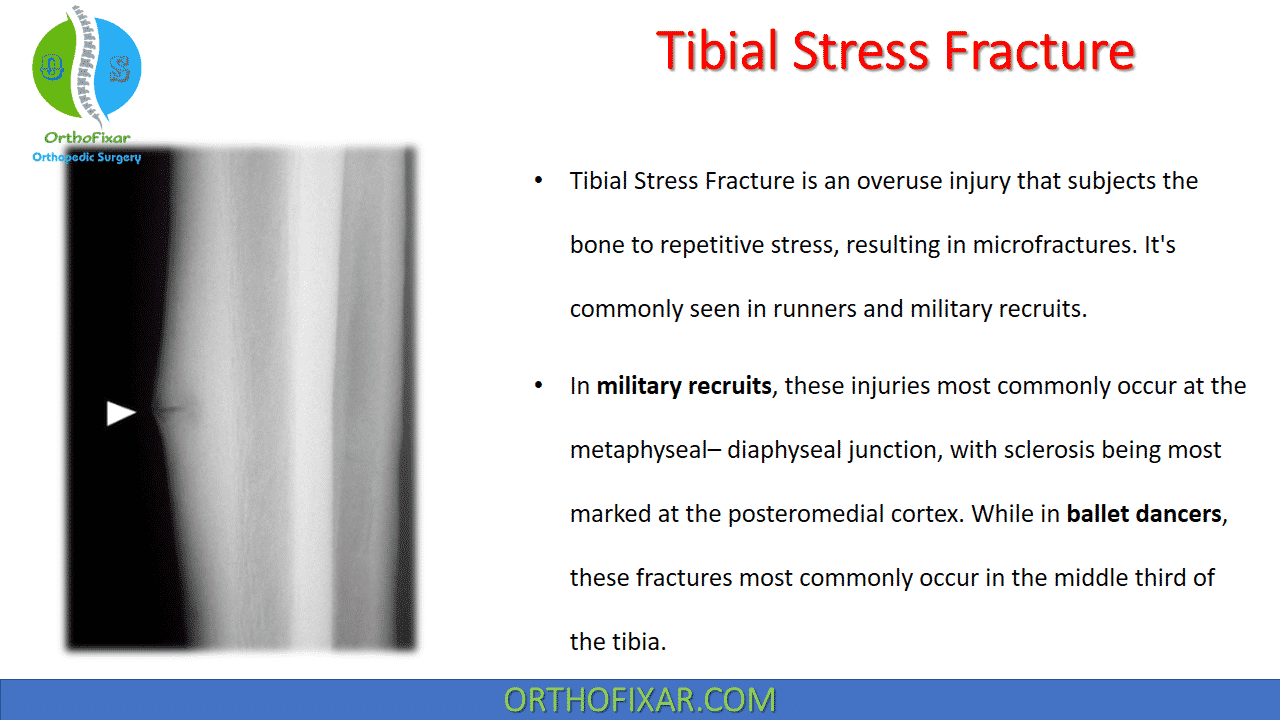  Tibial Stress Fracture 