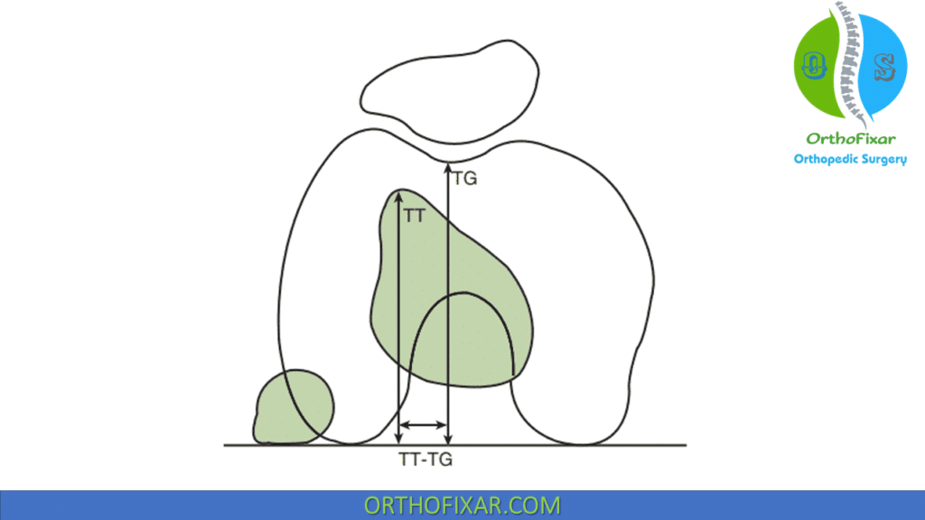 Tibial tuberosity trochlear groove TT-TG distance