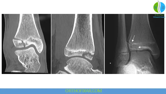 Tillaux-Chaput Fracture imaging