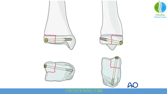 Tillaux-Chaput Fracture treatment