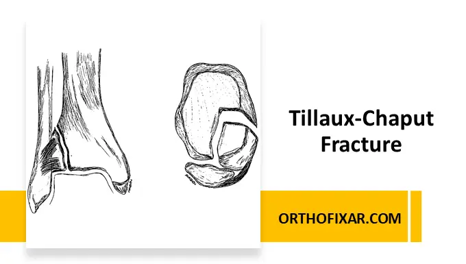Tillaux-Chaput Fracture