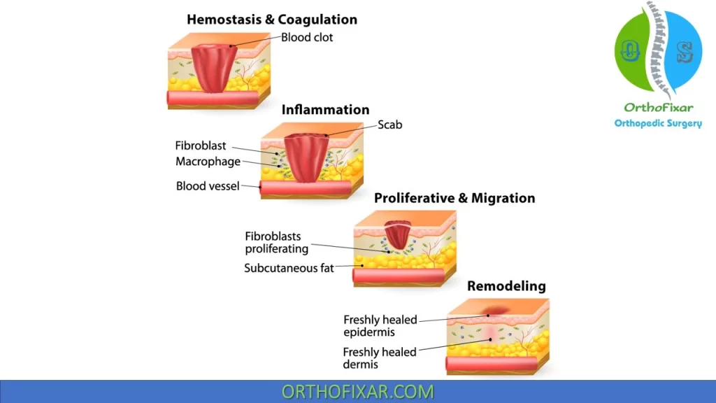 Soft Tissue Injury | OrthoFixar