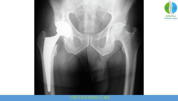 Total Hip Replacement