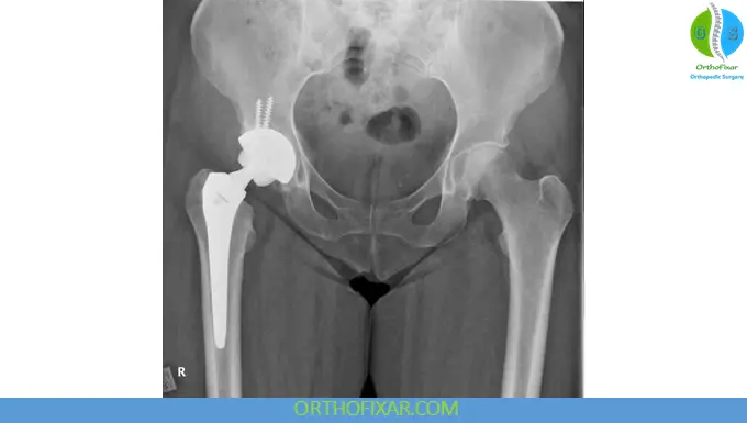 Total Hip Replacement