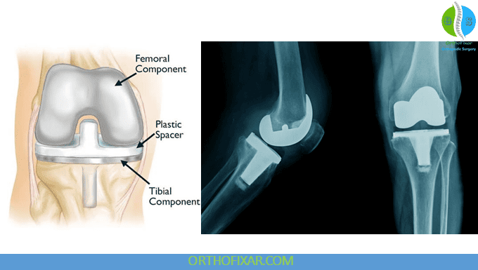 Partial vs Total Knee Replacement: Which Is Appropriate? 5 Total Knee Replacement