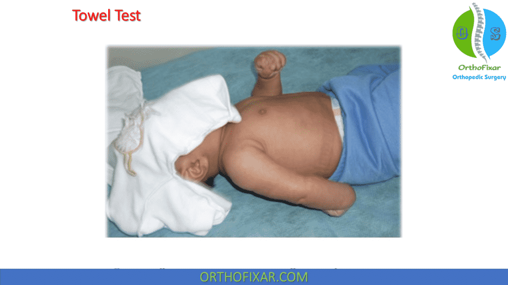 Towel Test brachial plexus palsy