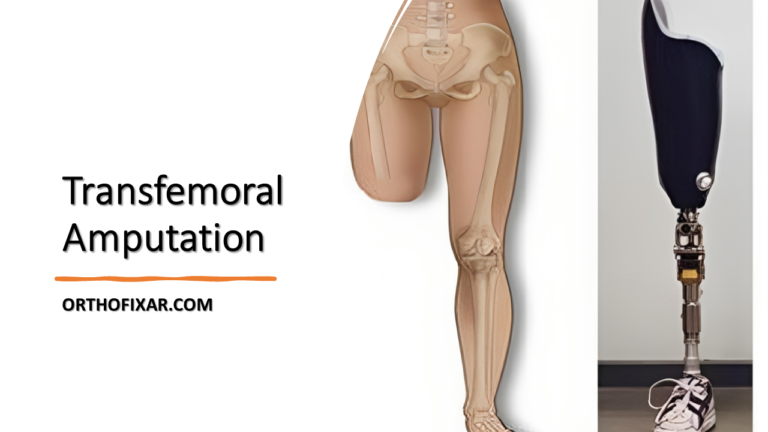 Transfemoral Amputation