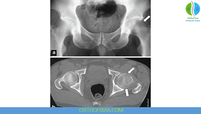 Transient Osteoporosis of the Hip: Symptoms & Recovery 5 Transient Osteoporosis of the Hip imaging