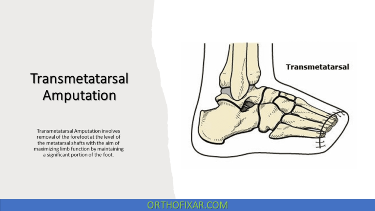 Transmetatarsal Amputation
