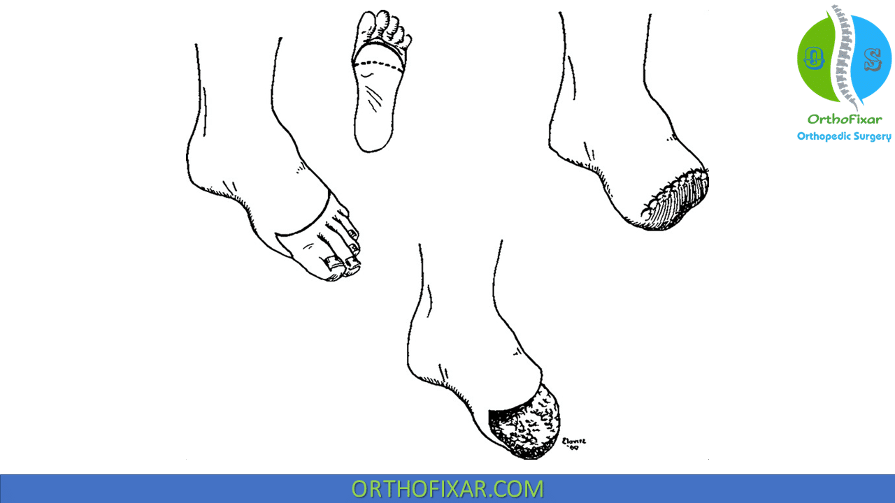 Foot Transmetatarsal Amputation 2023 | OrthoFixar