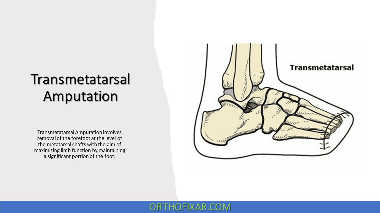  Foot Transmetatarsal Amputation 