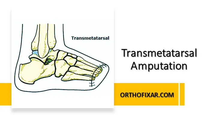 Transmetatarsal Amputation