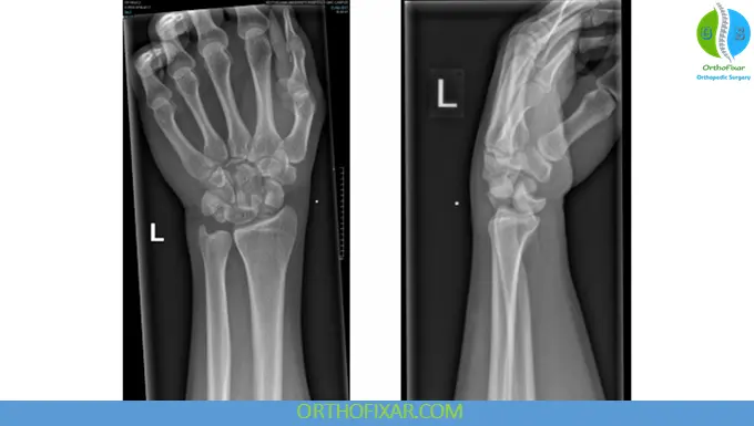 Transscaphoid perilunate fracture-dislocation