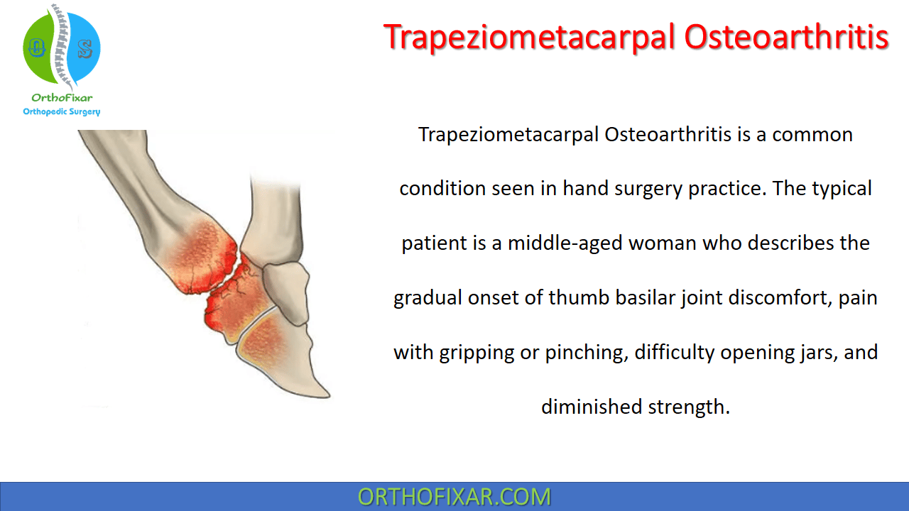 Trapeziometacarpal Osteoarthritis