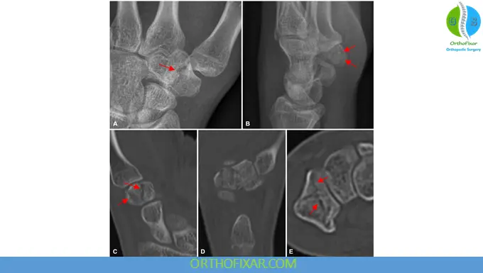 Trapezium Fracture xray