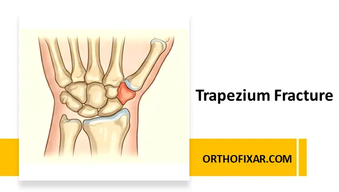 Trapezium Fracture