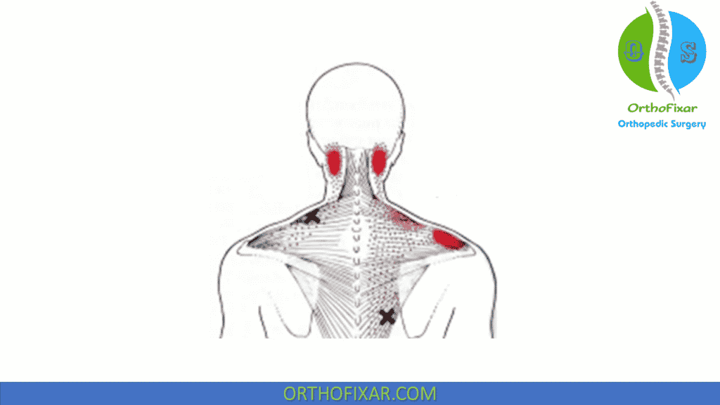 Trapezius Myalgia pain