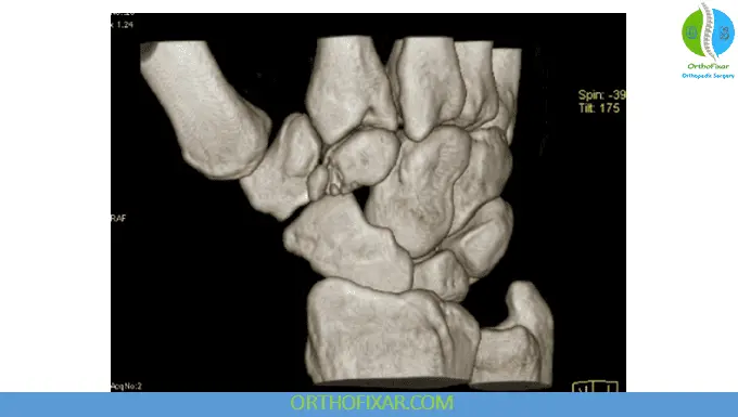 Trapezoid Fractures CT imaging