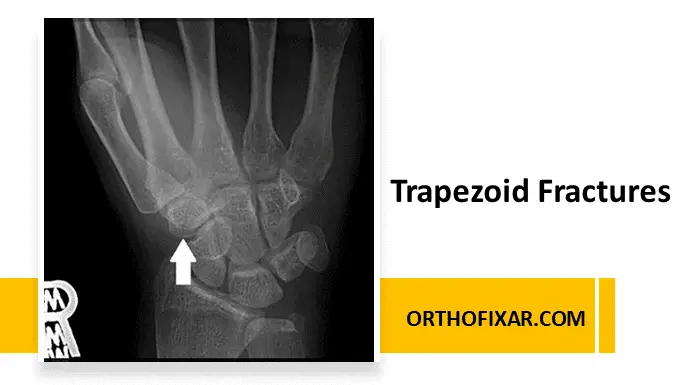 Trapezoid Fractures