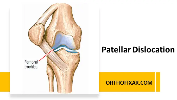 Traumatic patellar dislocation