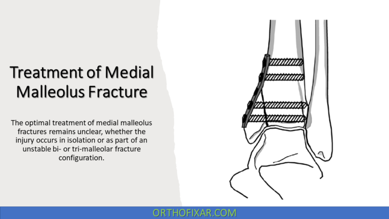 Treatment Of Medial Malleolus Fracture