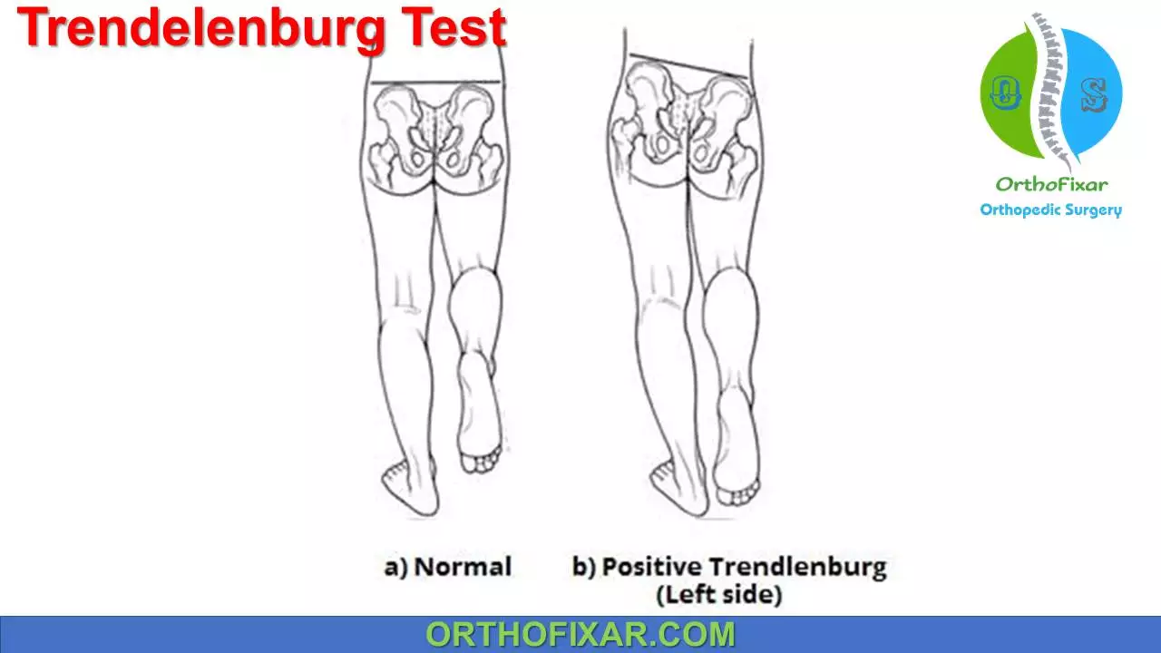 left side trendelenburg position