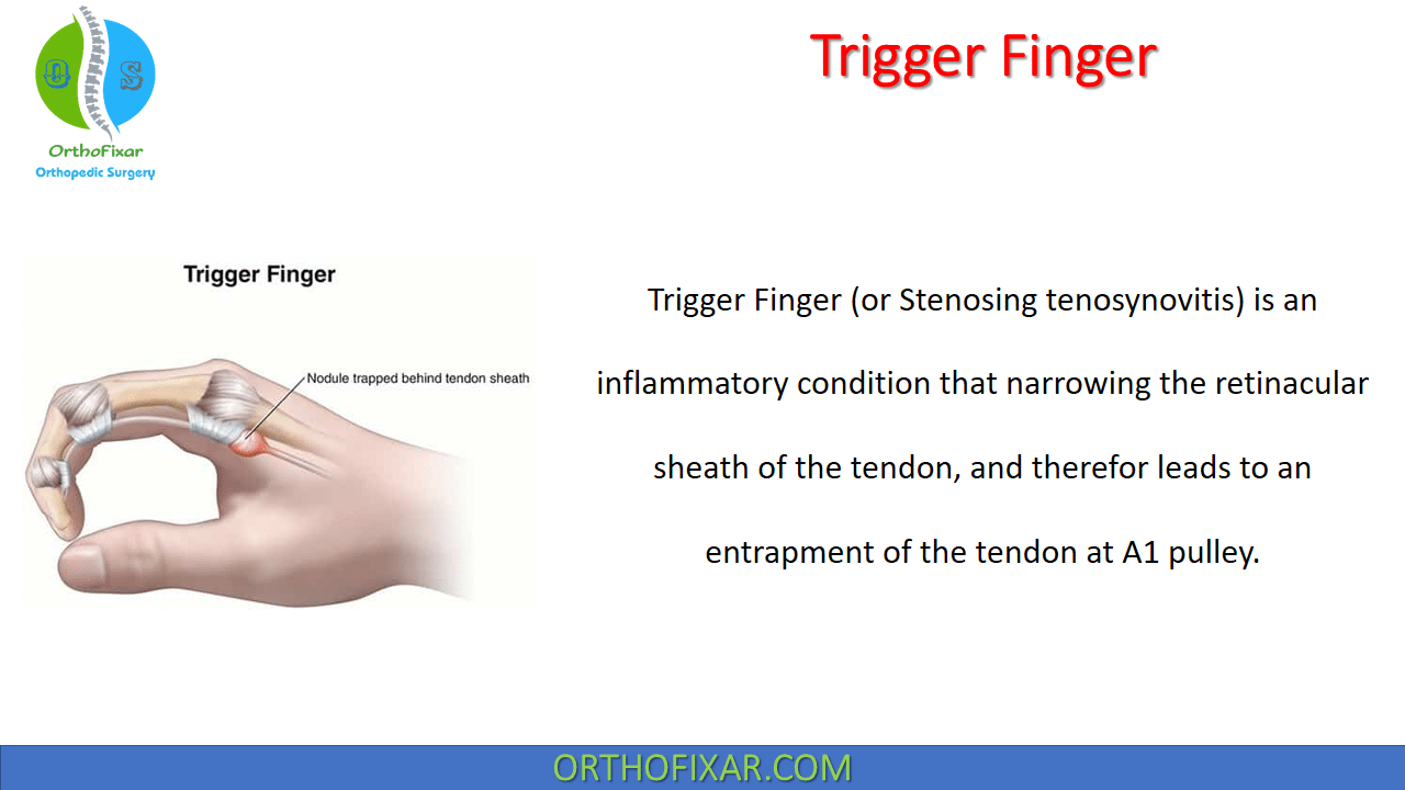 Trigger Finger | Stenosing Tenosynovitis