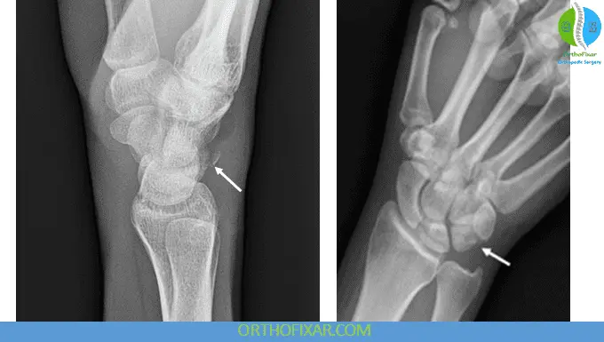 Triquetrum Fracture xray