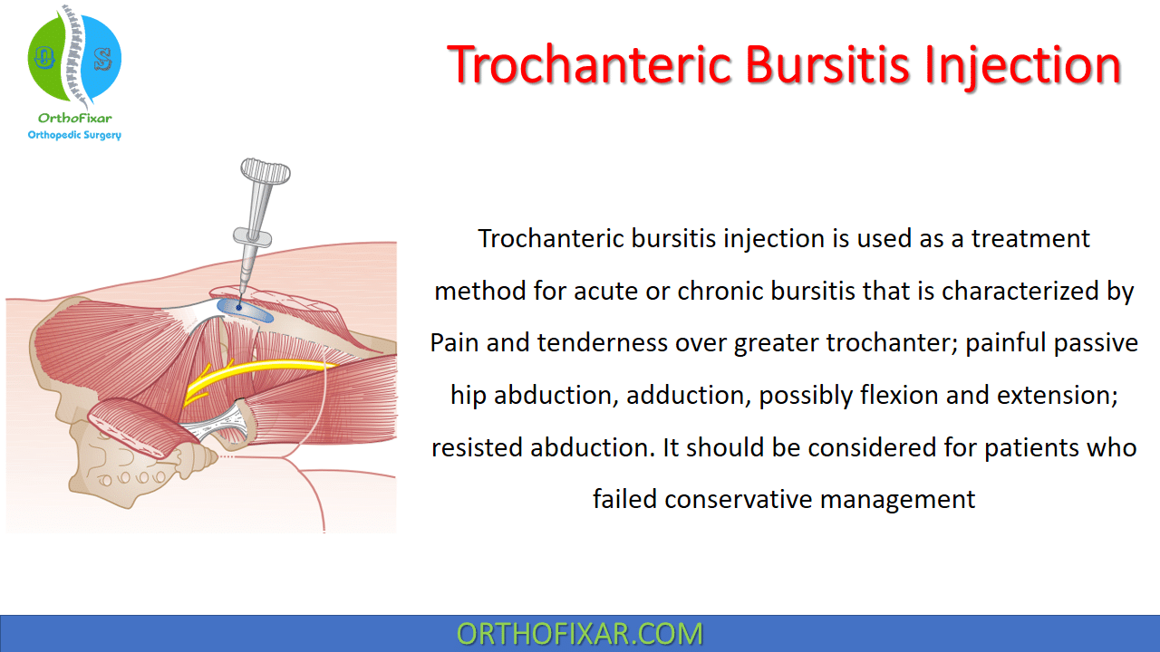 Trochanteric Bursitis Injection