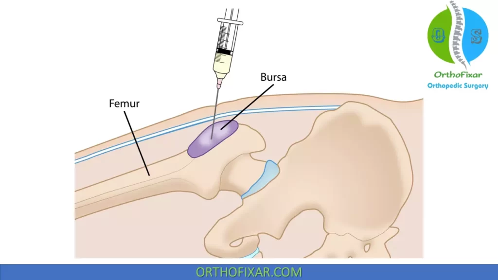 Trochanteric Bursitis steroid injection