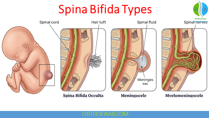 Spina Bifida in Adults: Symptoms, Complications & Care 4 Types of Spina Bifida