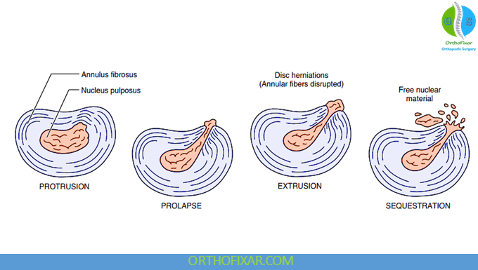 Types of disc herniations