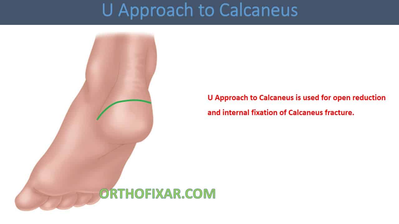  U Approach to Calcaneus 