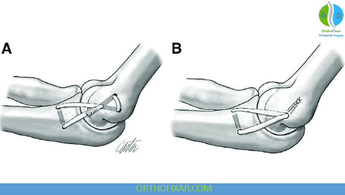 UCL Injury of the Elbow: Symptoms, Treatment & Recovery 7 UCL Injury of the Elbow surgery