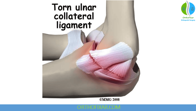 UCL Injury of the Elbow: Symptoms, Treatment & Recovery 6 UCL Injury of the Elbow