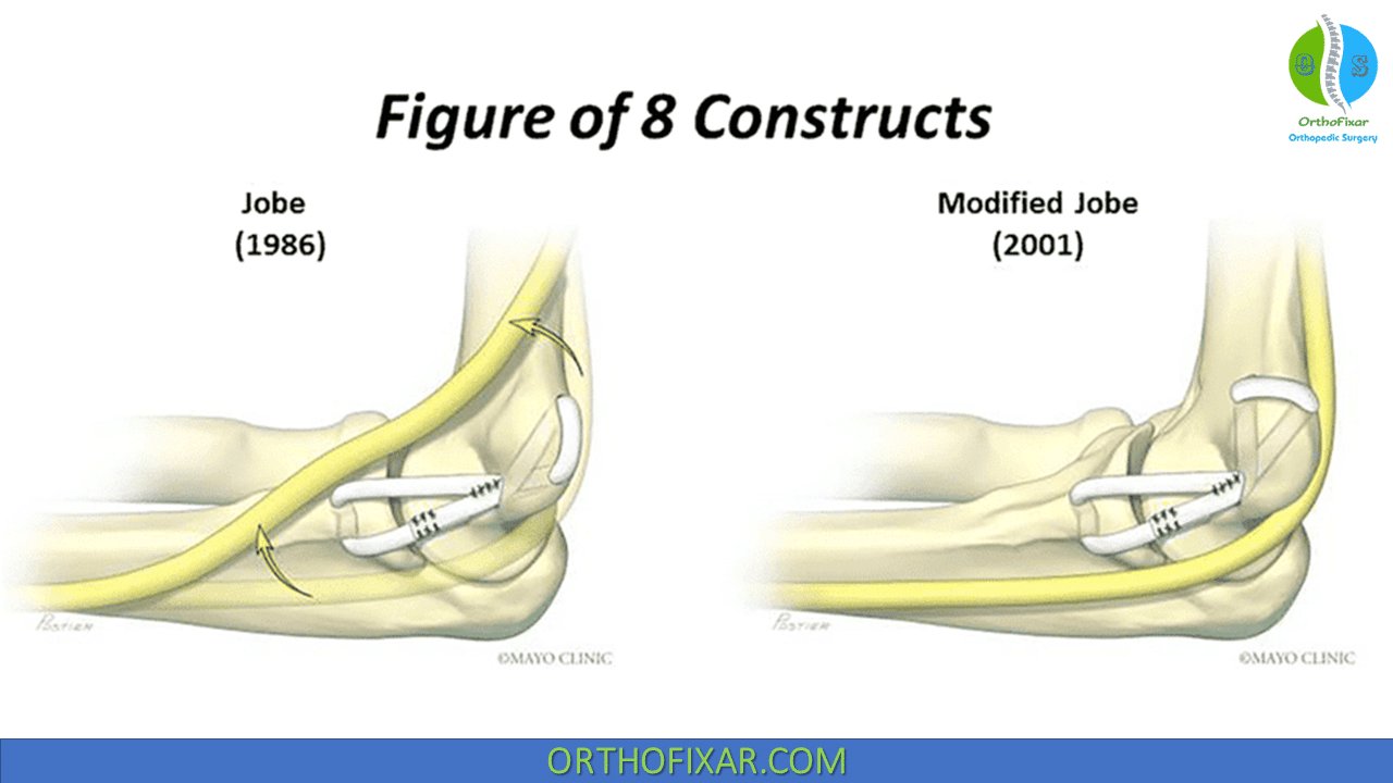 Elbow UCL Repair Surgery OrthoFixar 2025