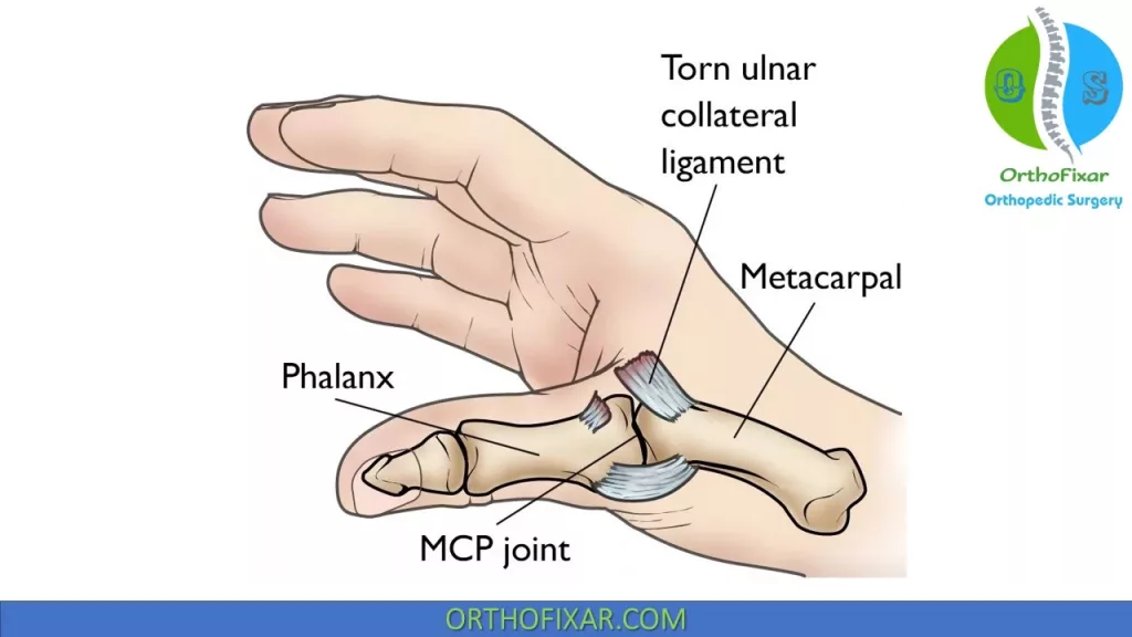 thumb Ulnar collateral ligament injury