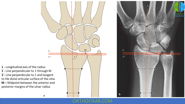 Ulnar Variance | OrthoFixar 2023