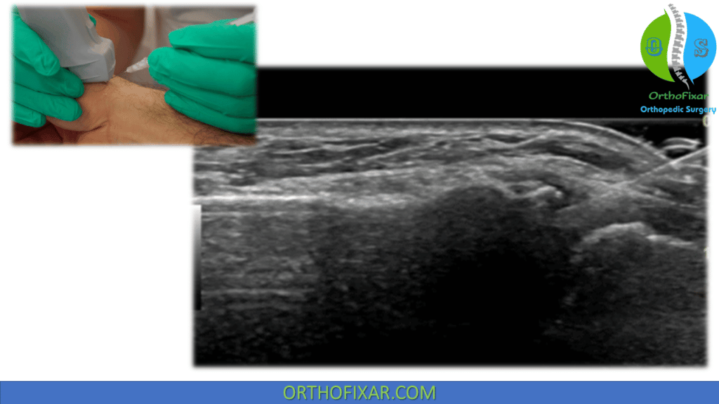 Ultrasound guided CMC Joint Injection