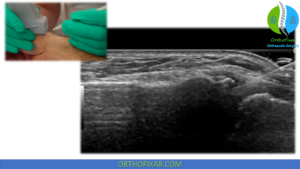 Trigger Point Cmc Joint Injection CMC Joint Injection Step-by-Step: Technique For Thumb Osteoarthritis